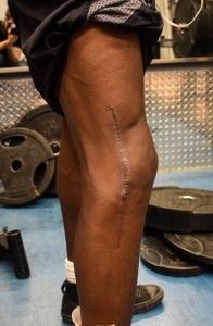 Zacary a dû attendre une semaine que son genou désenfle avant de pouvoir se faire opérer. (Photo: Félix Lacerte-Gauthier)